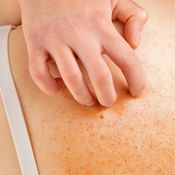 melanooma, ihosyöpä, kutina