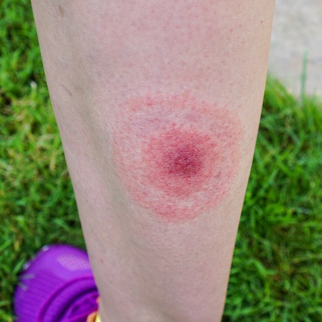 punkki, puutiainen, borrelioosi, Lymen borrelioosi