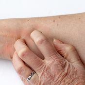 kutina, atopia, kuiva iho, kortisoni