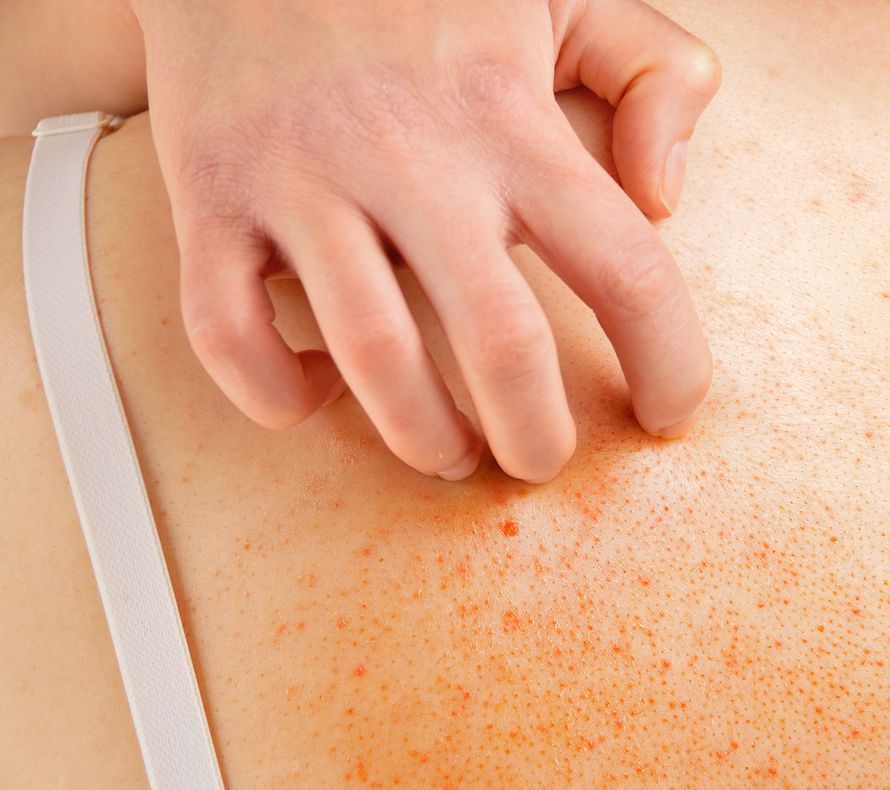 melanooma, ihosyöpä, kutina