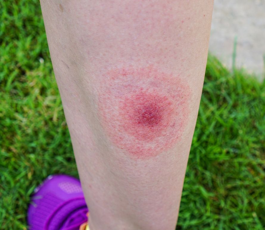 punkki, puutiainen, borrelioosi, Lymen borrelioosi