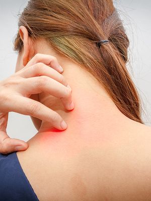 kutina, atopia, kuiva iho, kortisoni, täi