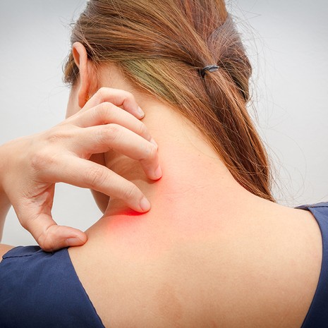 kutina, atopia, kuiva iho, kortisoni, täi