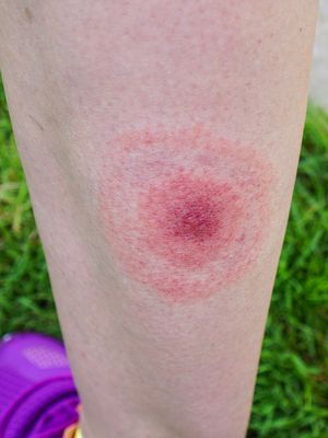 punkki, puutiainen, borrelioosi, Lymen borrelioosi