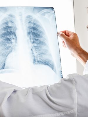 Mikä on sarkoidoosi, miten sitä hoidetaan?