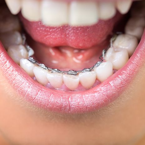 aikuisen hampaiden oikomishoito