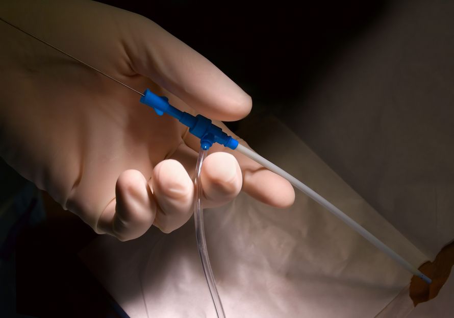  katetrointi sydän katetriablaatio