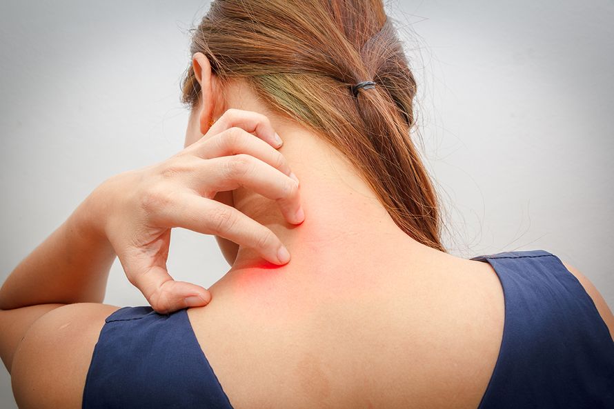 kutina, atopia, kuiva iho, kortisoni, täi