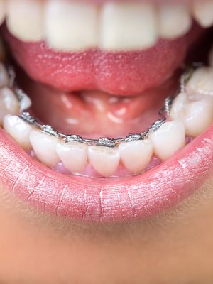 aikuisen hampaiden oikomishoito