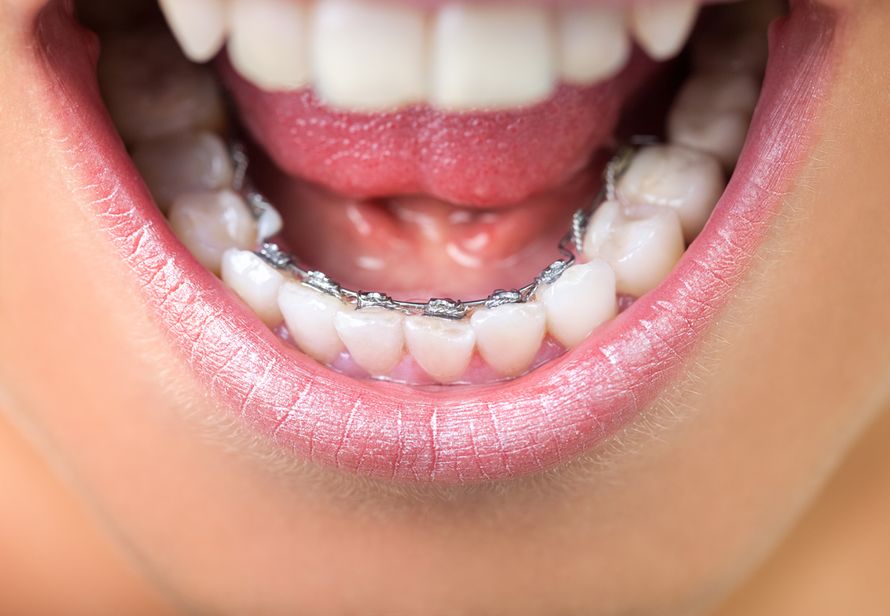 aikuisen hampaiden oikomishoito