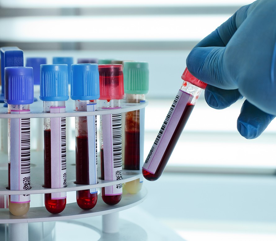 laboratoriokokeet, kolesteroli, verenpaine, sokerirasitus