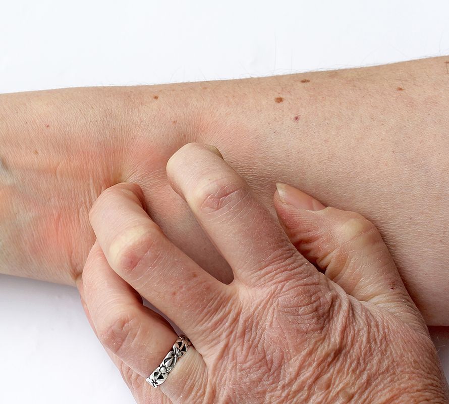 kutina, atopia, kuiva iho, kortisoni