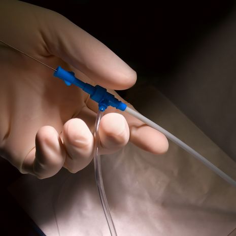  katetrointi sydän katetriablaatio